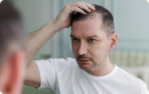Man Looking At His Receding Hairline In The Mirror And Experiencing Male Pattern Baldness