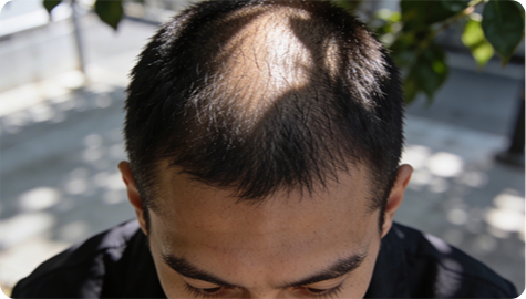 what is a hair graft