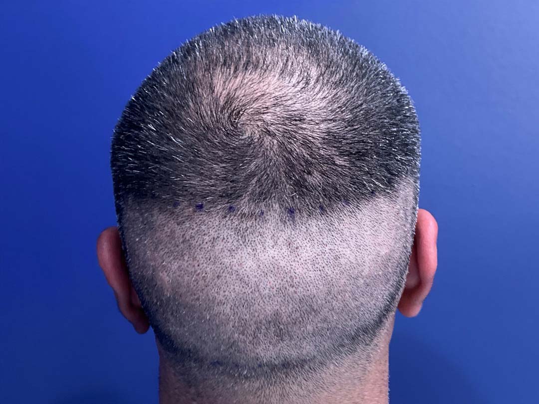vinay-donor-day-2 Healing After FUE Hair Replacement