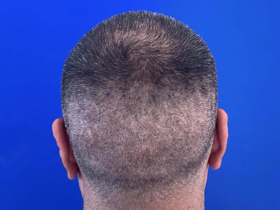 vinay-donor-day-5 Healing After FUE Hair Replacement