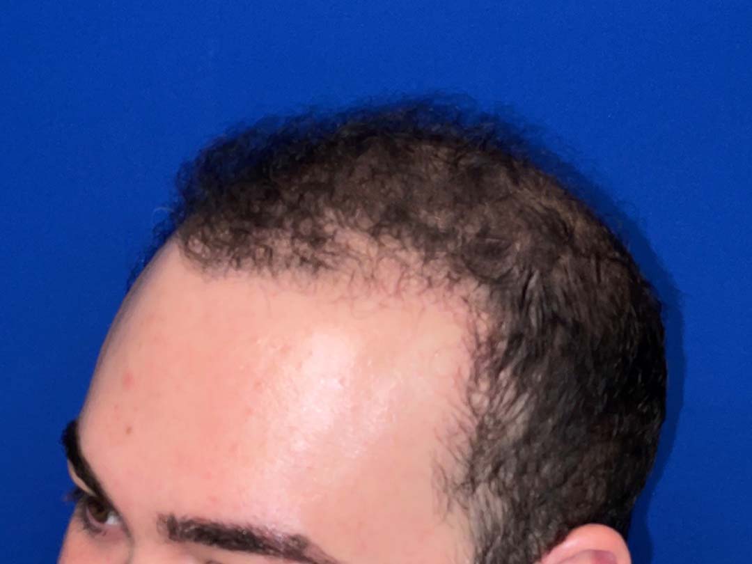 12 months hair transplant chicago