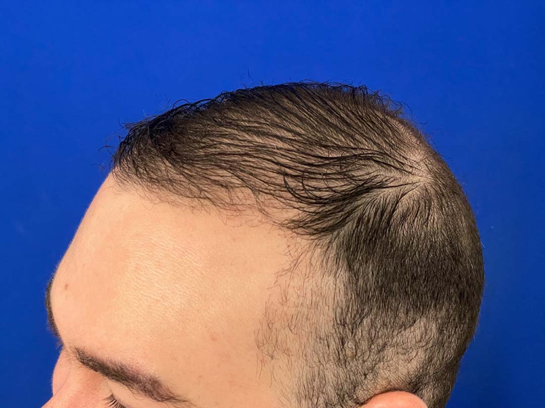 18 months after hair restoration results chicago