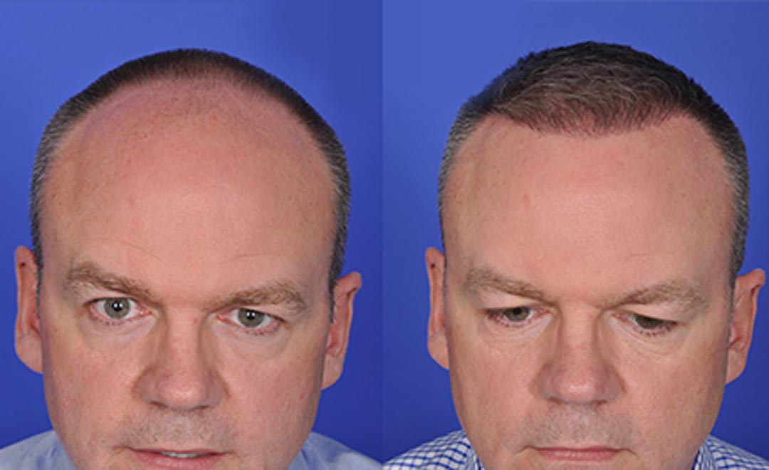 before and after fue hair transplant chicago il