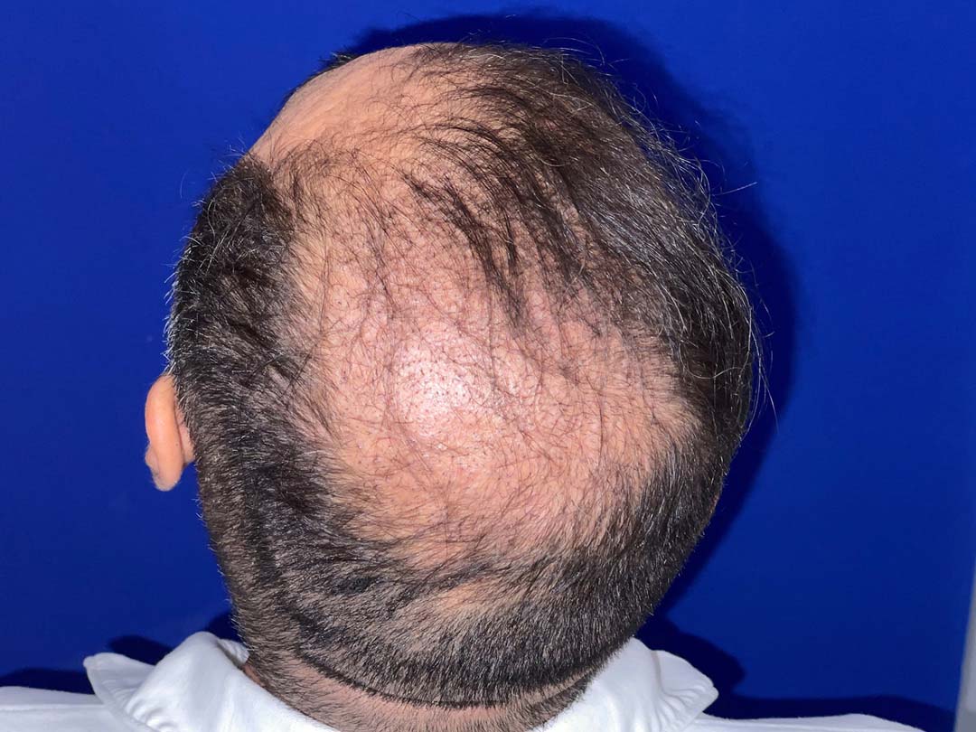 day 10 of a hair restoration chicago