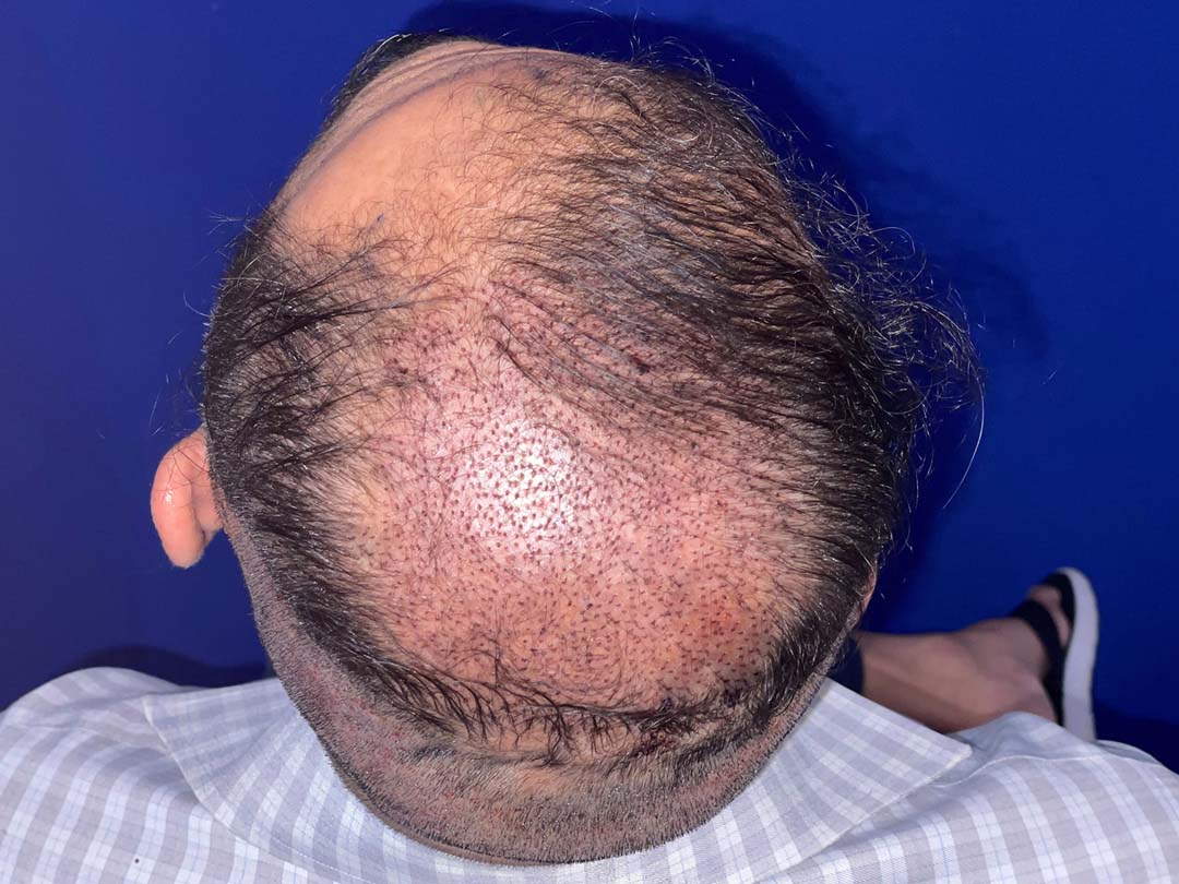 day 2 of a hair restoration transplant chicago