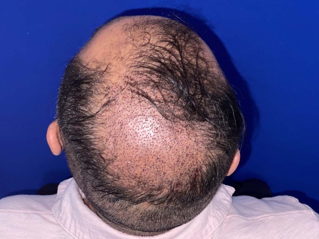 day 5 of a fue hair transplant chicago IL