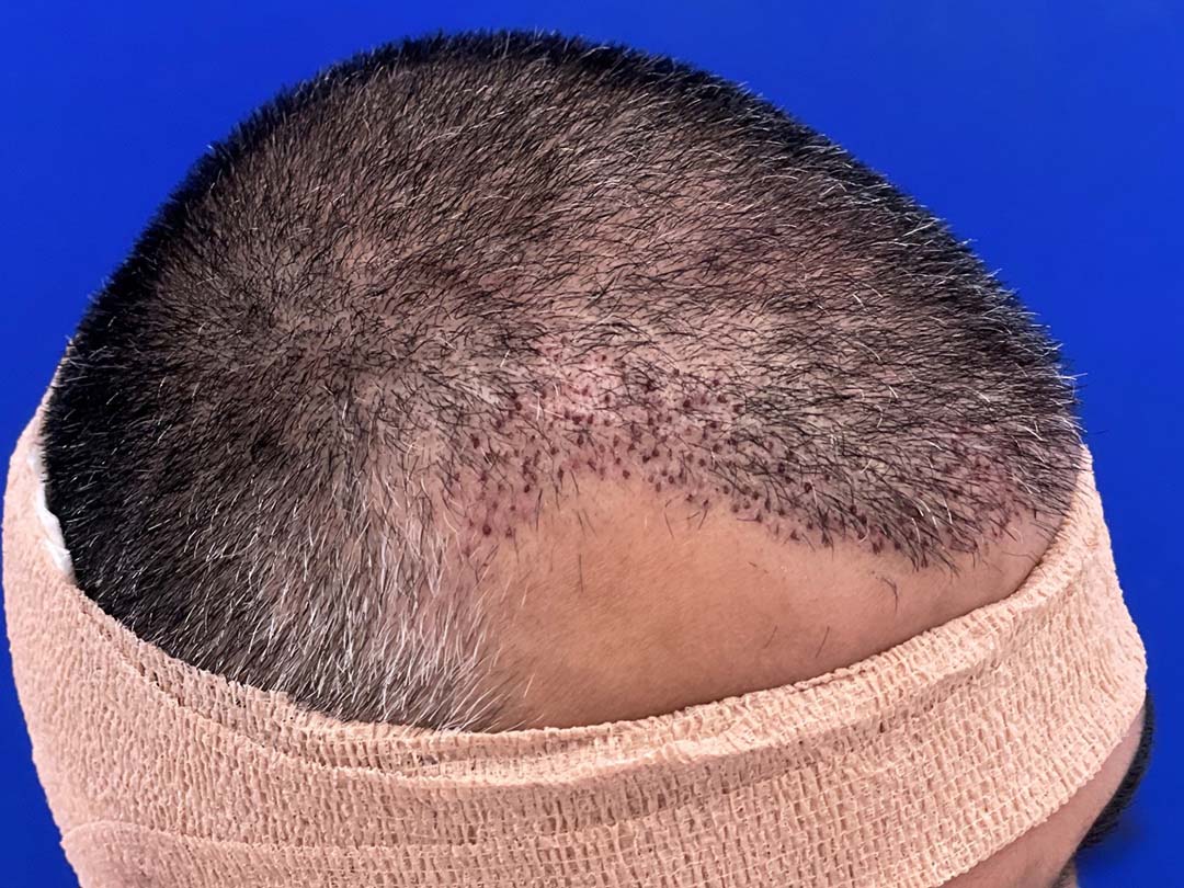 day of hair transplant chicago