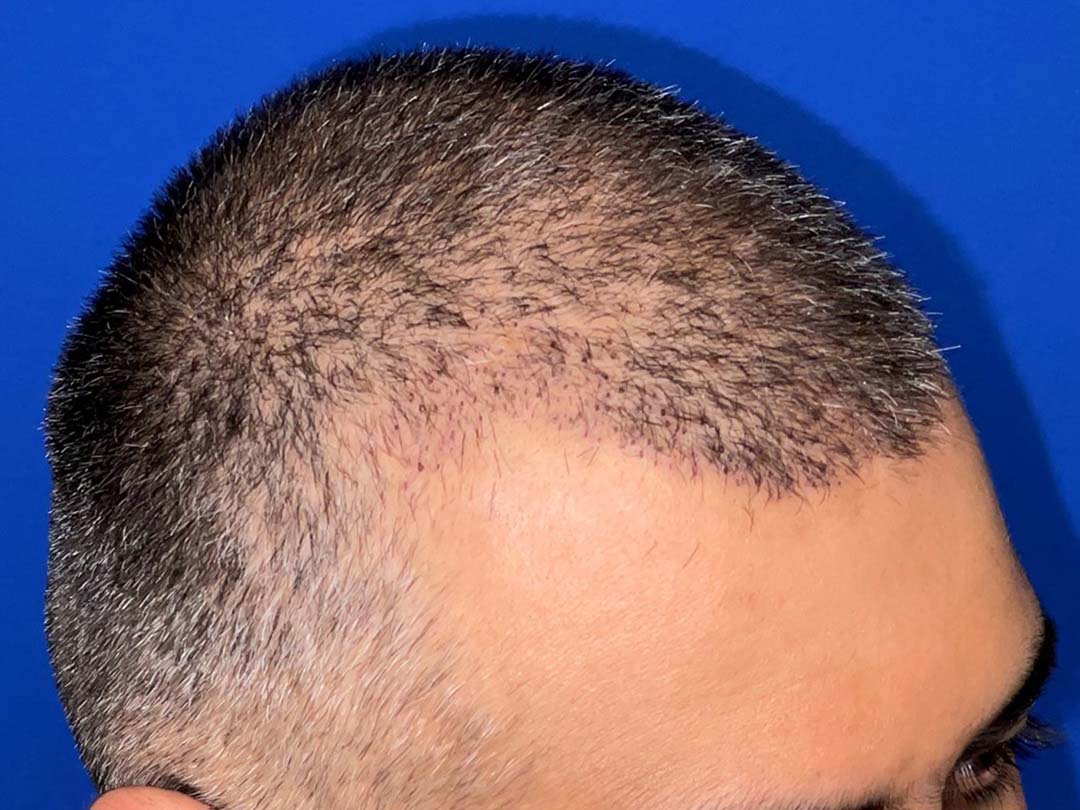 five days after hair restoration results chicago