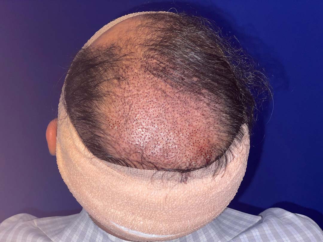 fue hair restoration pictures chicago il