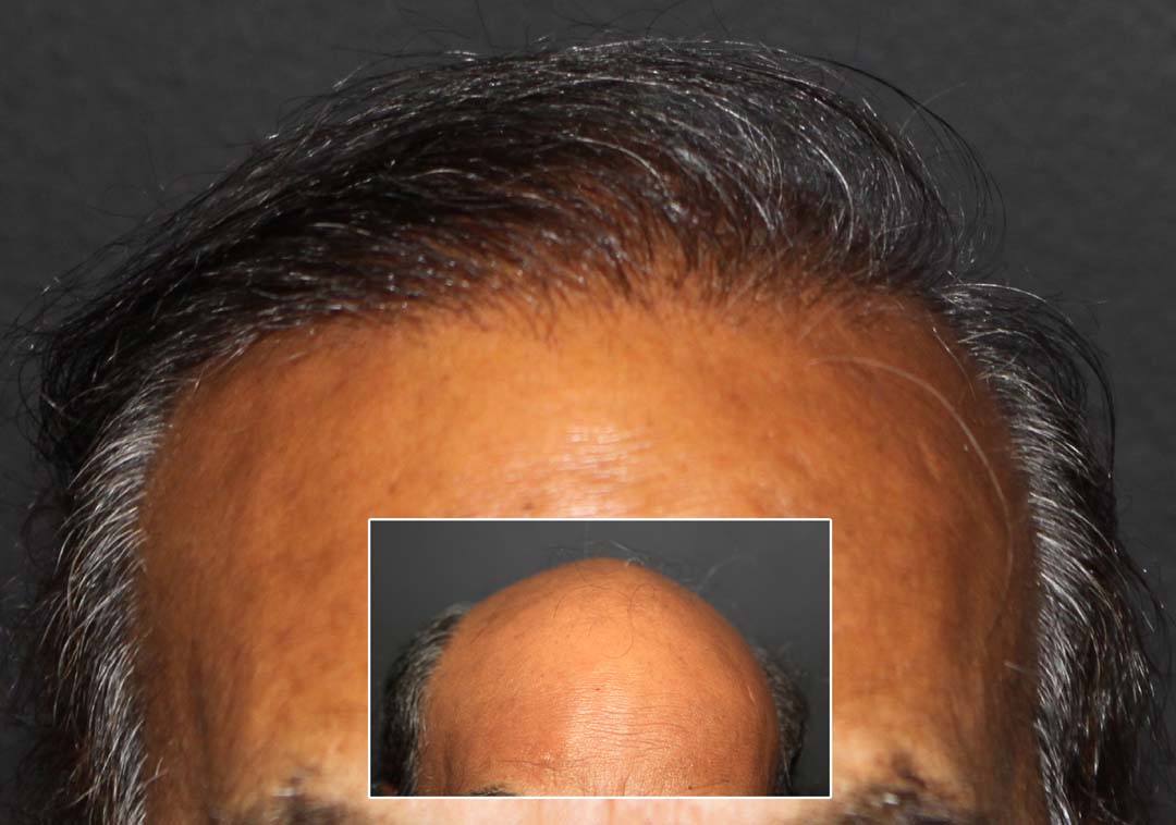 fue hair transplant before and after chicago il