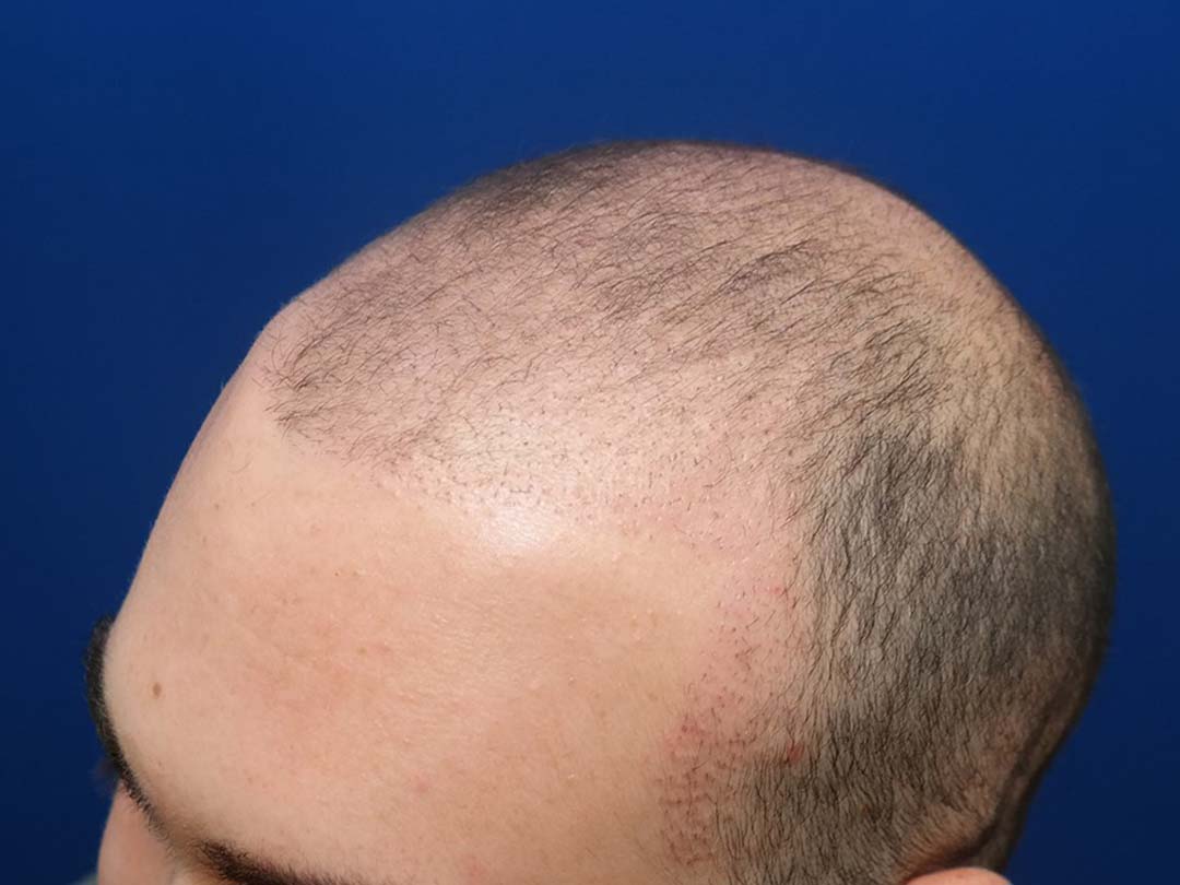 Solve Clinics  FUE Hair Transplant Before 11 months postprocedure  This patient had 1200 grafts placed in his hairline to establish a hairline  and create density Each one of our hair transplants