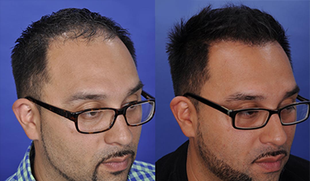 fue transplant before and after chicago il