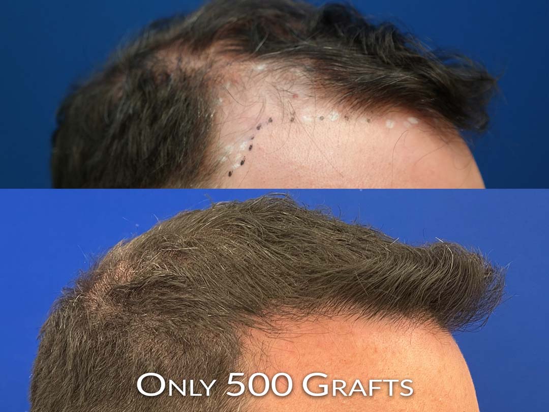 hair restoration before and after chicago IL