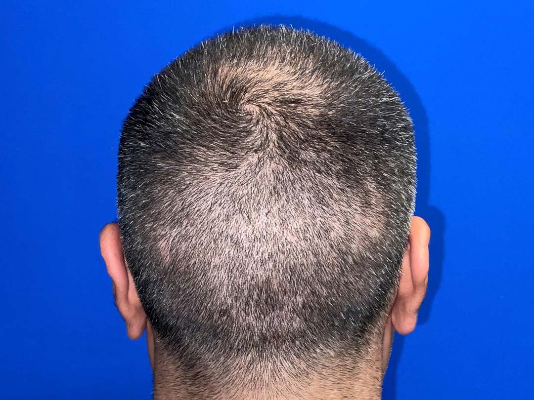 hair transplant day 10 growth chicago