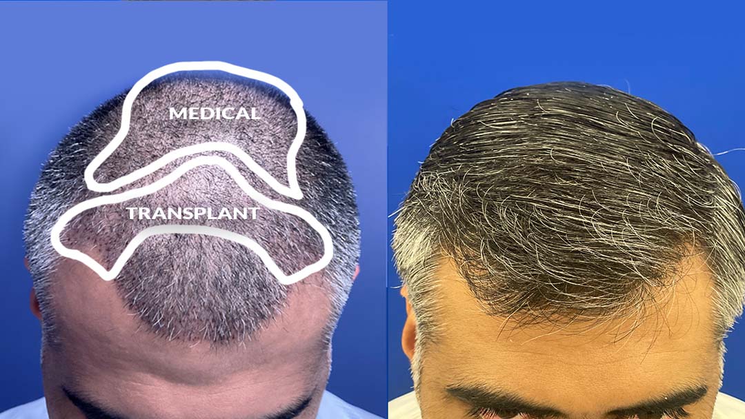 hair transplant results chicago il