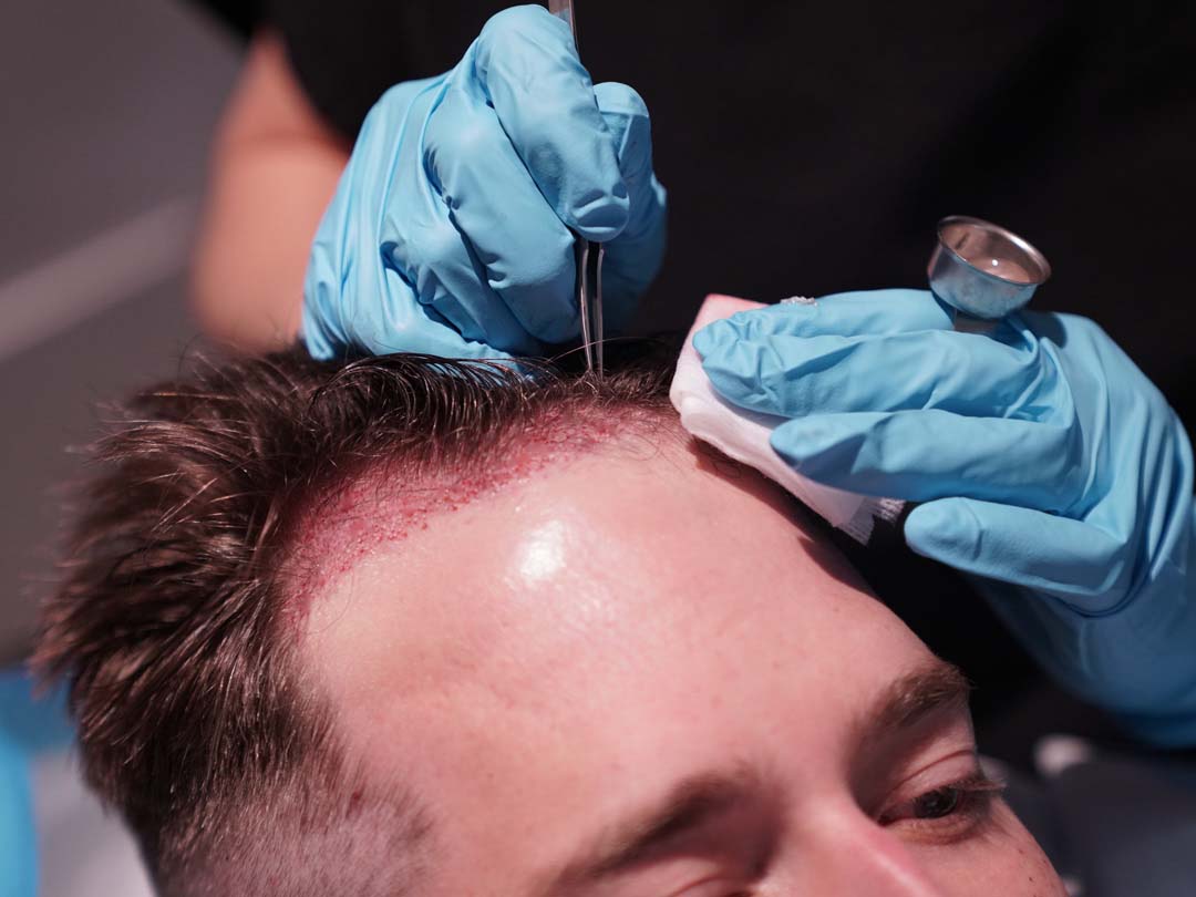 hair transplantation procedure chicago il