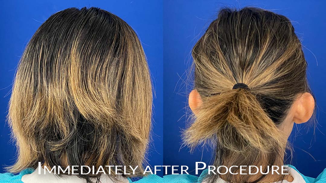 photos of fue hair restoration chicago