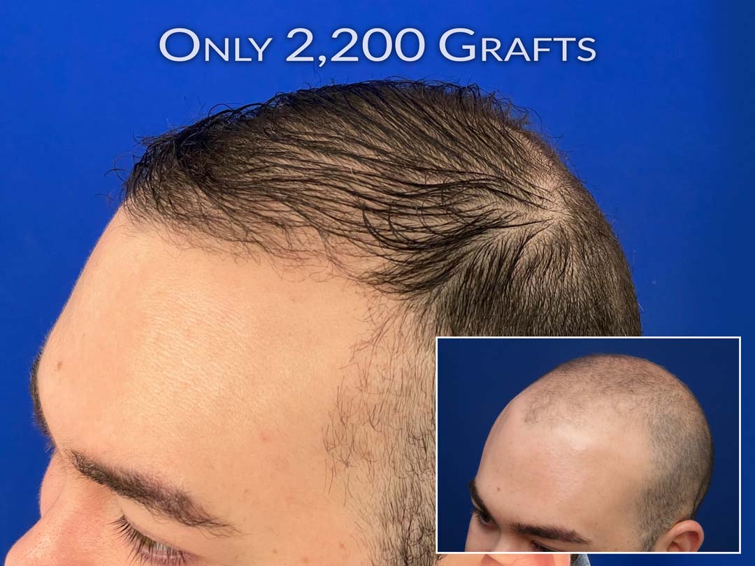 results of fue hair transplant chicago