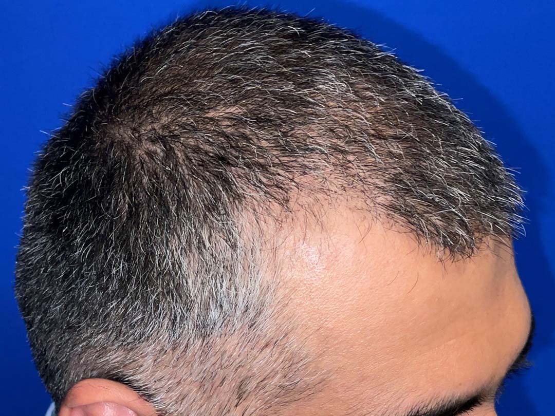 ten days after hair restoration chicago