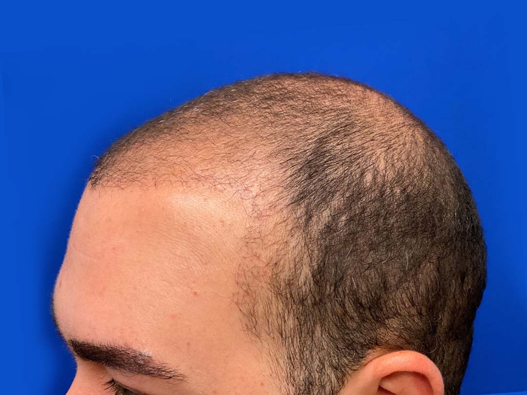 what to expect 6 months after a hair transplant chicago il.jpg