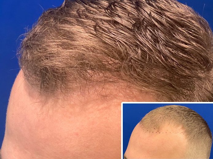 hair restoration before and after chicago IL