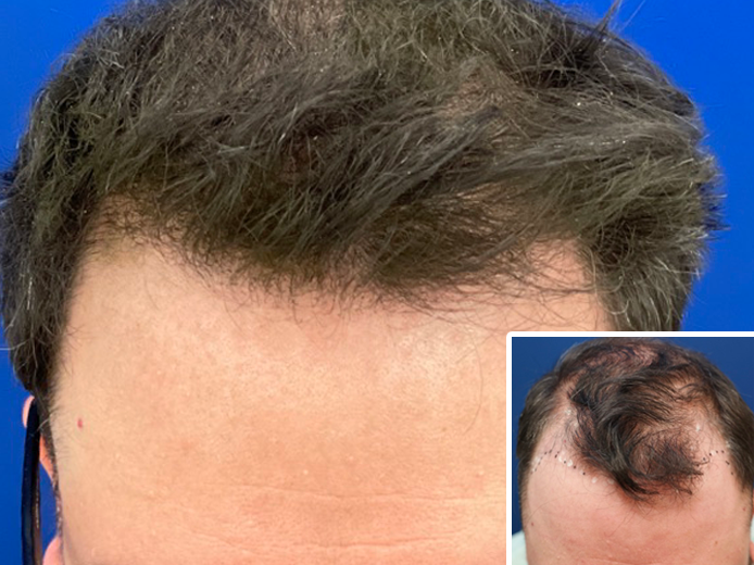 results no shave fue hair replacement chicago IL