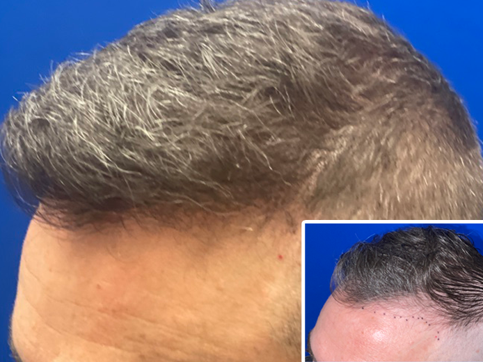 hair restoration before and after chicago IL