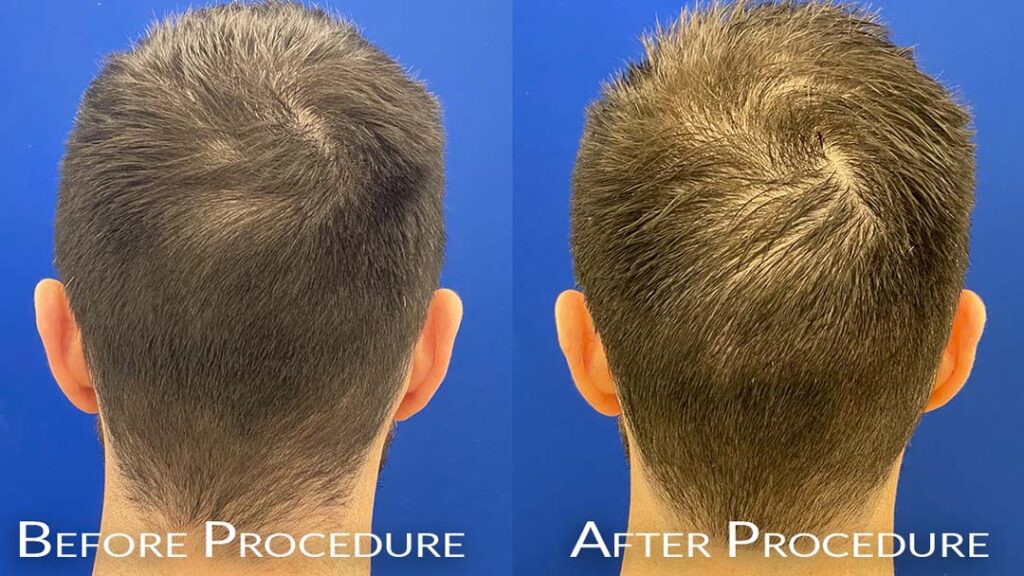 before & after fue hair restoration chicago il