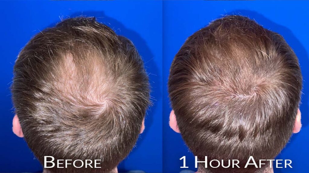 before and after hair micropigmentation chicago IL