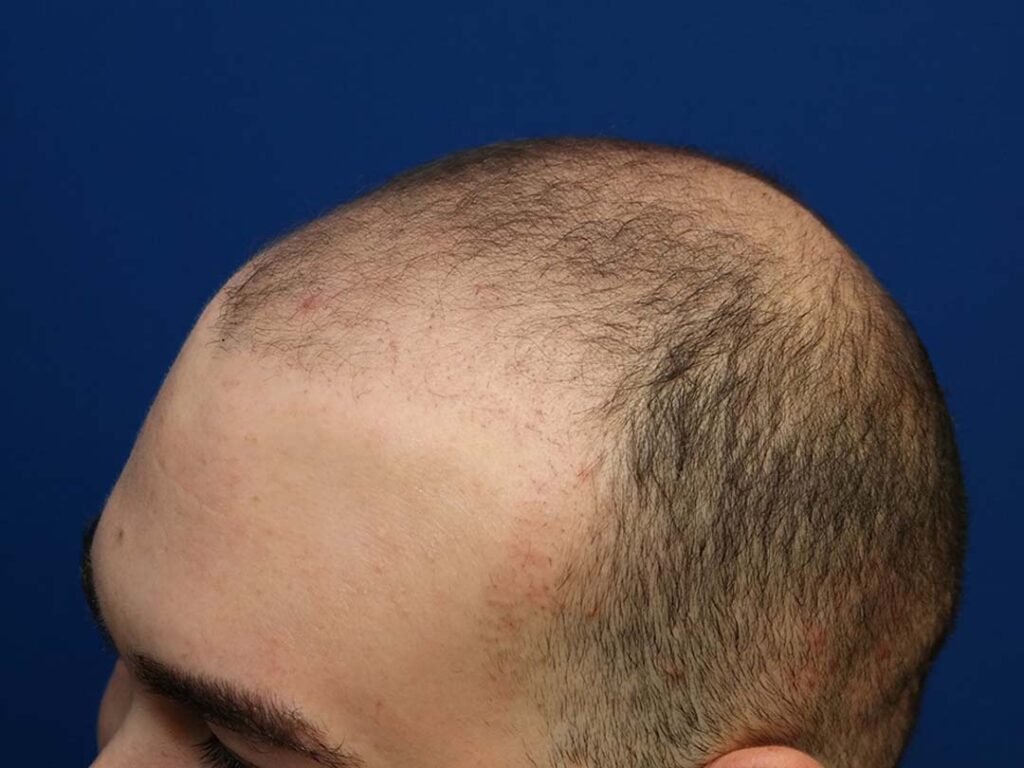 hair transplant growth after 3 months