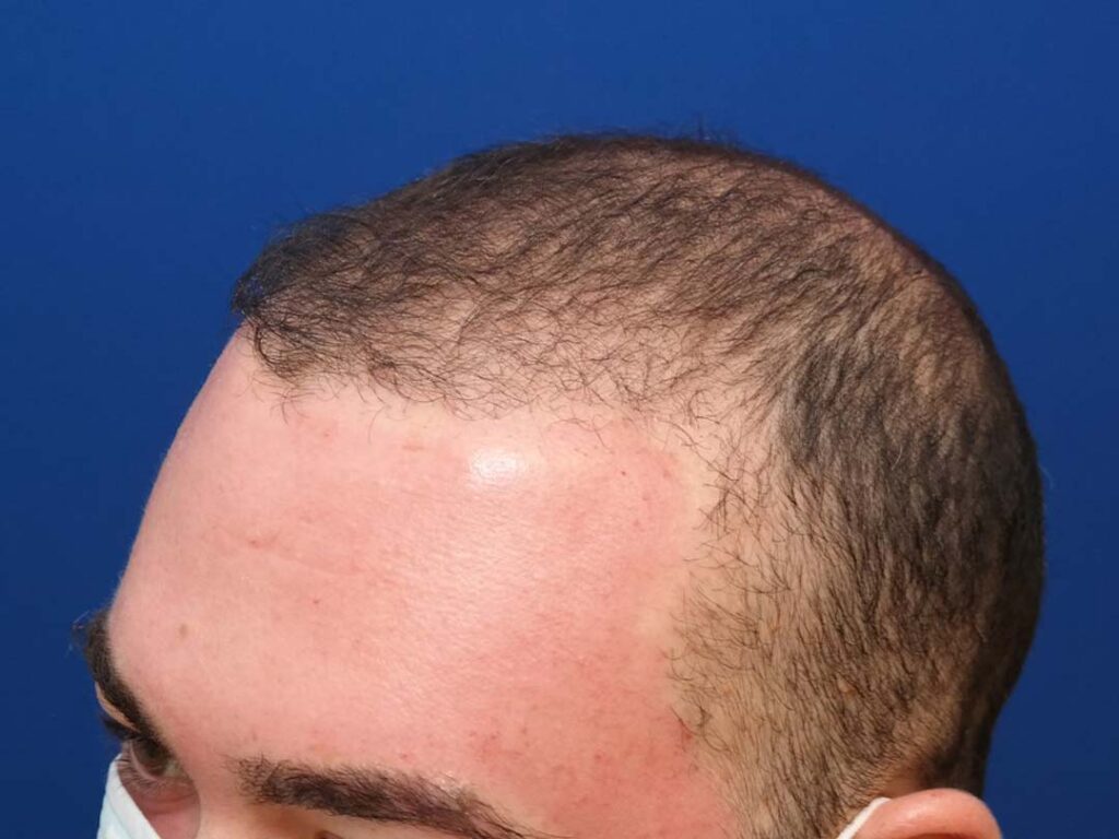 hair transplant 9 months post op chicago il 1
