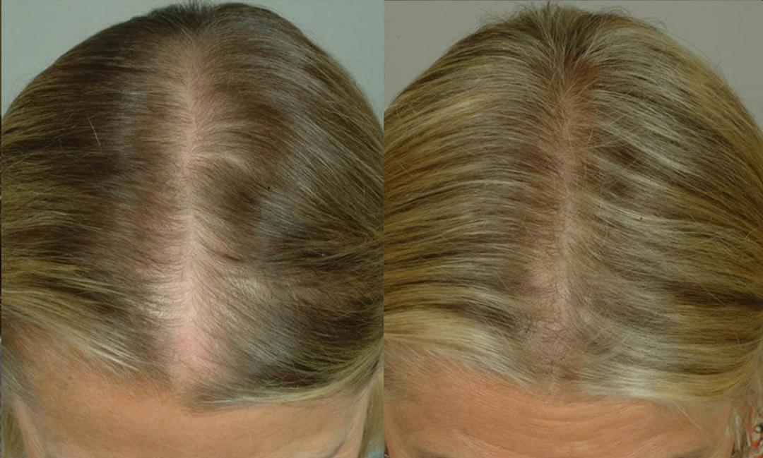 laser-cap-pt-2-female