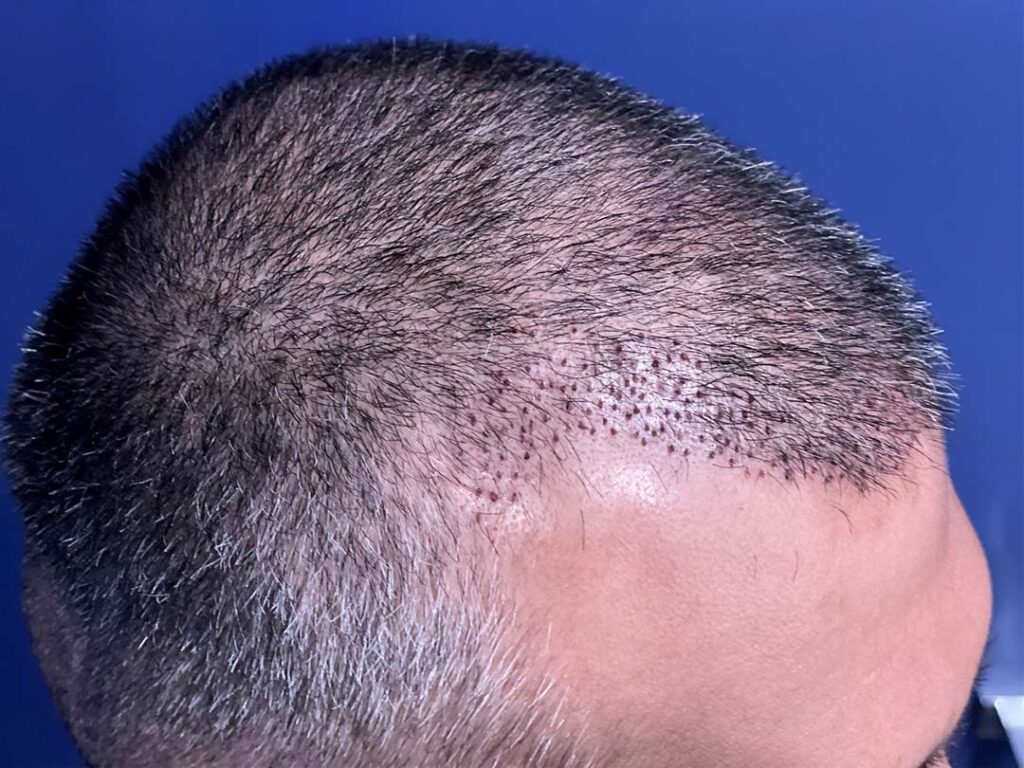 two days after hair transplant chicago IL