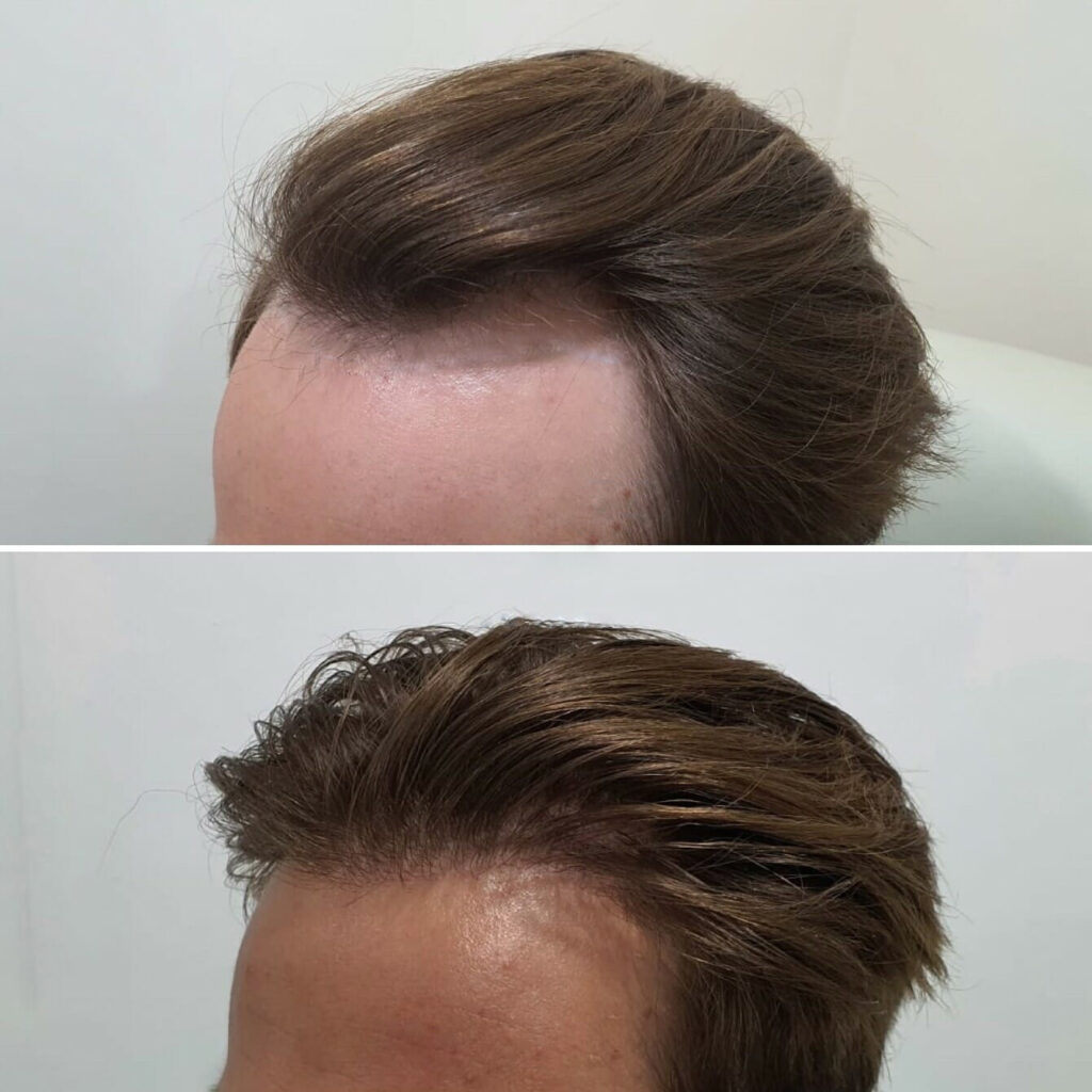 Receded-Hairline-FUE-Hair-Transplant-Before-and-after-1-water-mark-removed