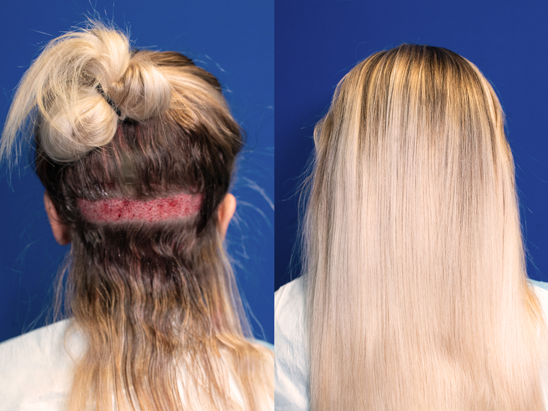 alicia-concealed-FUE-side-by-side-strip-corrected