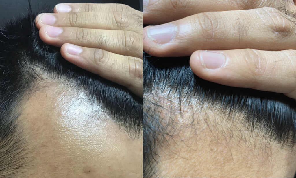 hairstim-pt-6