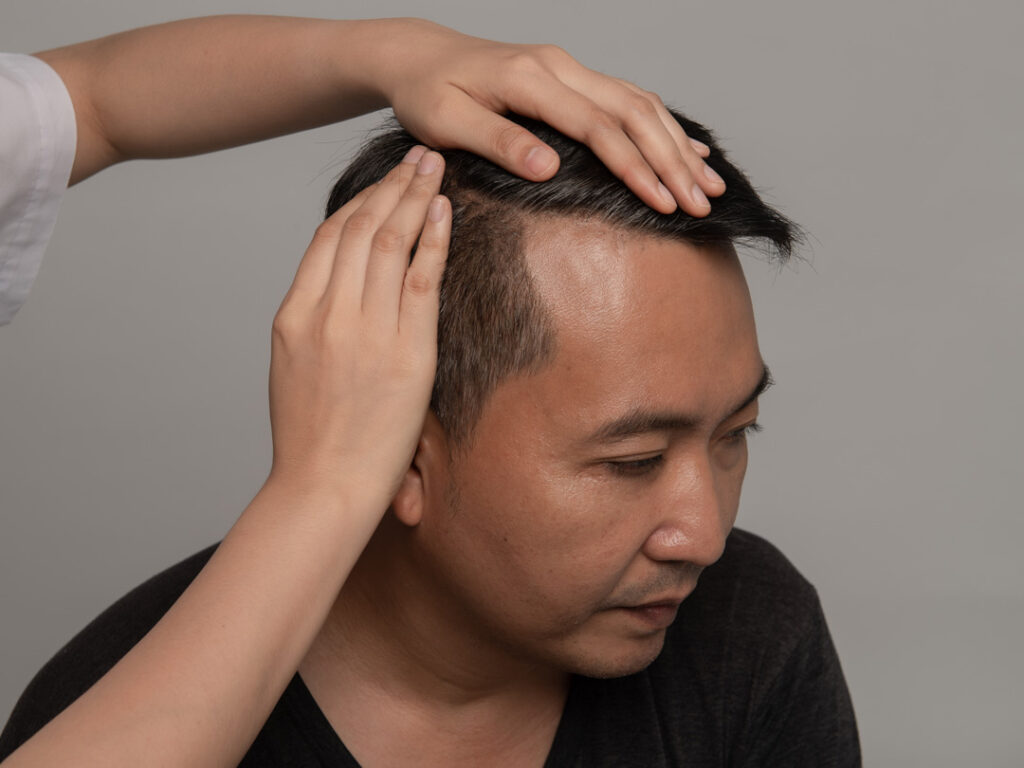 male-evaluate-hairline