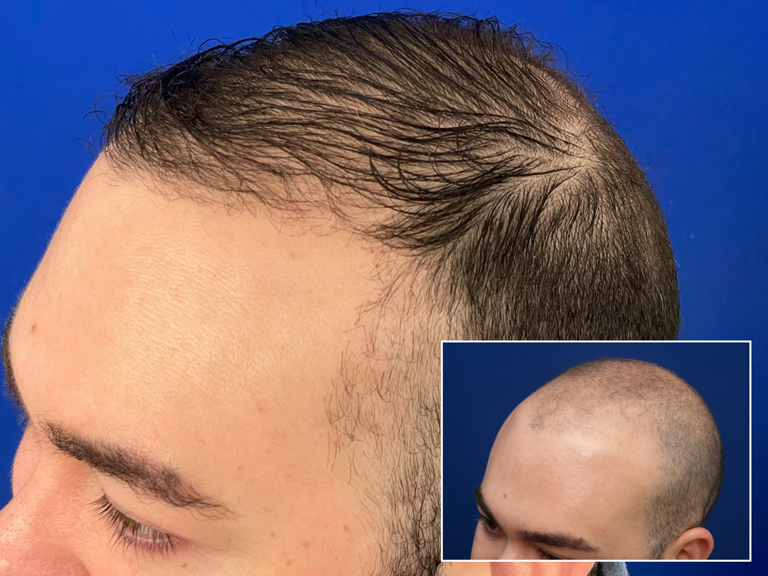 marshall-before-and-after