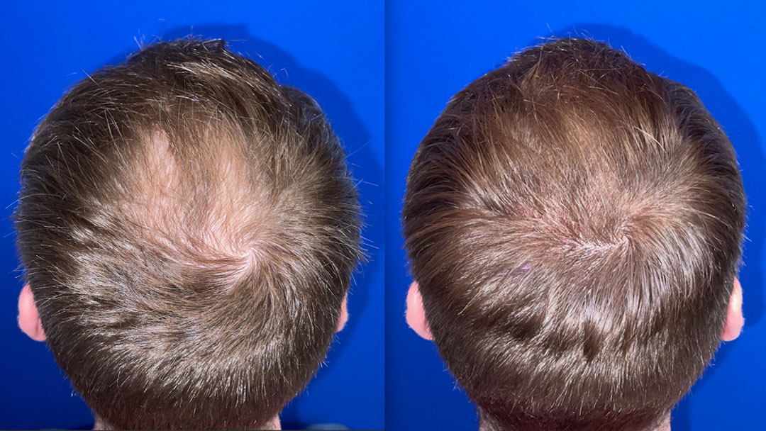 micropigmentation-before-and-after