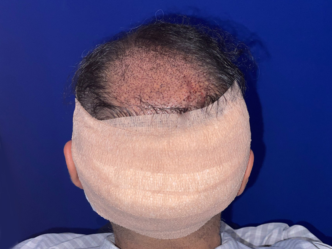 rajesh-crown-recovery-day-0