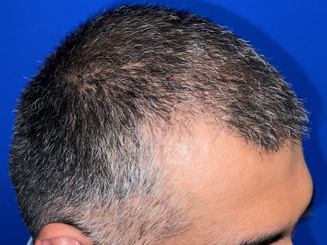 vinay-recovery-micro-day-10