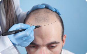 Are There Any Types of Hair Loss You Don’t Treat?