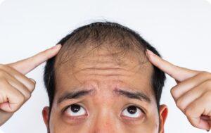 Do I Need A Biopsy For My Hair Loss?