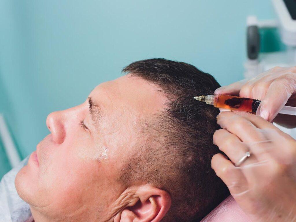 Can You Style Your Hair After a Hair Transplant