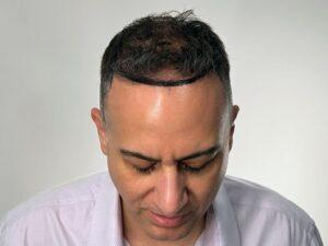 FUE Hair Transplant Procedure | Northwestern Hair