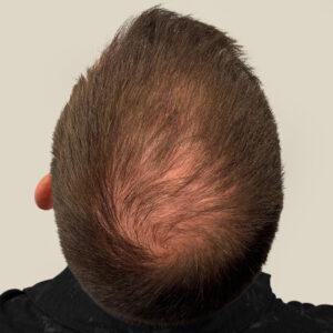 Brady, 48 años, hombre, trasplante capilar Micro PUE® Chicago, coronilla, 4.729 injertos, fotos de antes y después