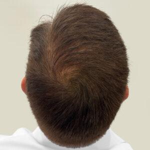 Brady, 48 años, hombre, trasplante capilar Micro PUE® Chicago, coronilla, 4.729 injertos, fotos de antes y después