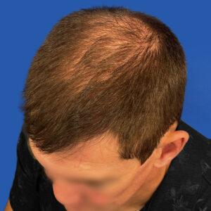 Brady, 48 años, hombre, trasplante capilar Micro PUE® Chicago, coronilla, 4.729 injertos, fotos de antes y después