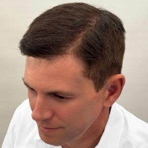 Brady, 48 años, hombre, trasplante capilar Micro PUE® Chicago, coronilla, 4.729 injertos, fotos de antes y después