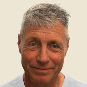 Dane, 62 años, hombre, trasplante capilar Micro PUE® en Chicago, coronilla, 2773 injertos, resultados antes y después